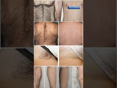 Laser hair removal ｜before & after