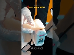 witness the non-invasive lifting power of HIFU