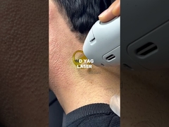 ND YAG laser hair removal for the dark hair
