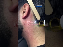 Diode Laser vs ND YAG Laser, which one you prefer?