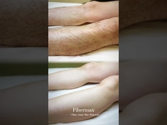 Introducing the latest Fiber Laser Hair Removal Machine, Astiland Fibermax!