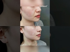 Have You Tried RF+ HIFU for Skin Tightening? #AntiAging #SkinLift #beautyclinic  #facialtreatment